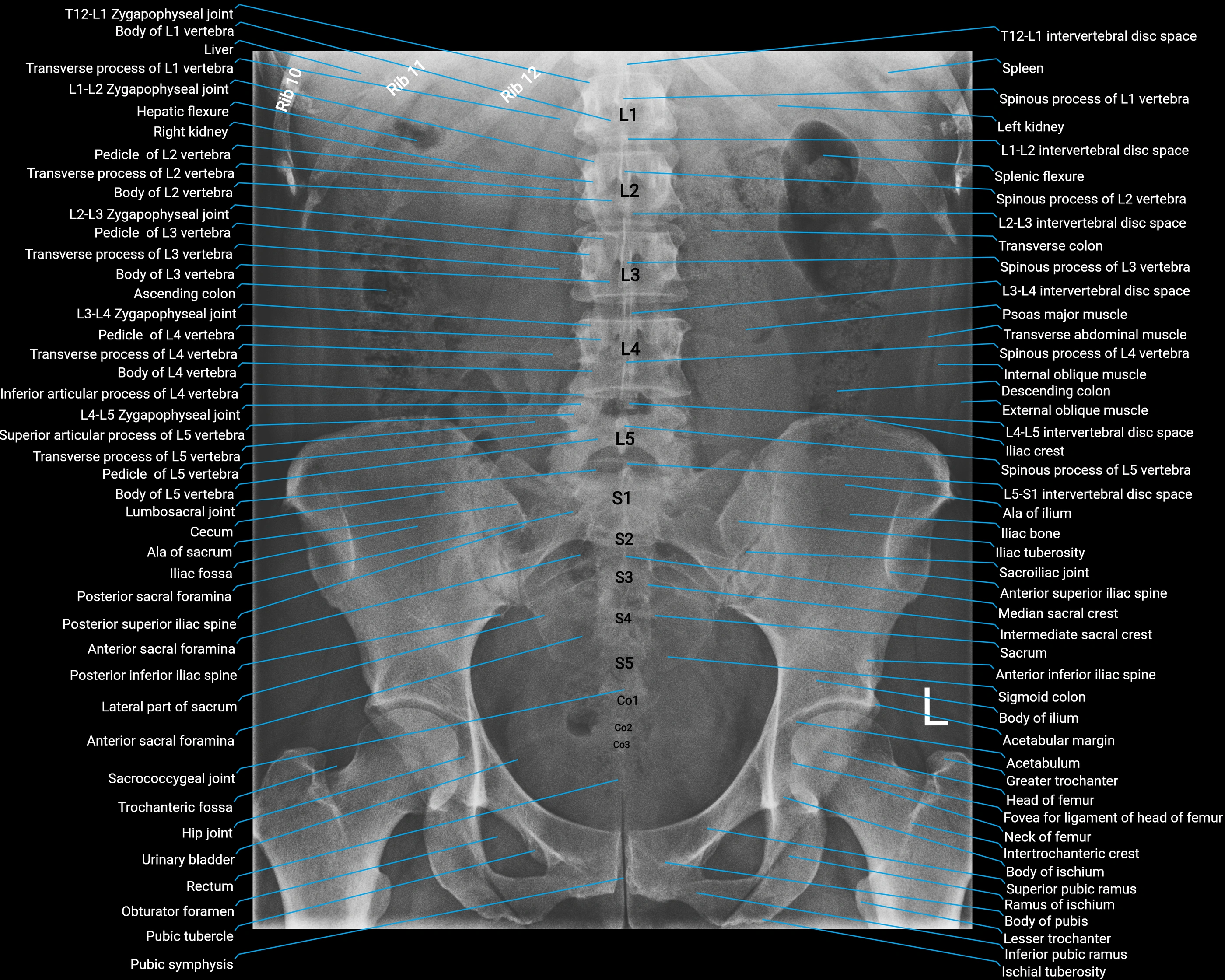 X Ray abdomen AP anatomy labelled.webp